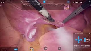 VirtaMed LaparoS™ - Uterine Vessel Coagulation