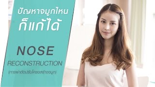 #แก้จมูก แบบเน็ตไอดอล ด้วย Nose Reconstruction - พิพลอย