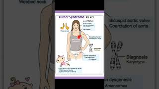 Turner's syndrome