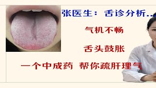 气机不畅，舌头鼓胀？一个中成药，帮你疏肝理气