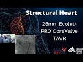 26mm Evolut-PRO CoreValve TAVR - March 13, 2018