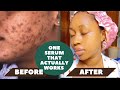 How to Get rid of Dark Spots FAST|One Product Needed|Result in 7 days