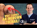 How ingrown toenails are removed! Dr. Nick Campitelli