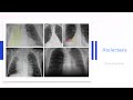 Atelectasis: Chest X-ray Atlas