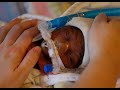 PREMATURE BIRTH: CAUSES, RISKS AND MANAGEMENT - Orange Health Lounge