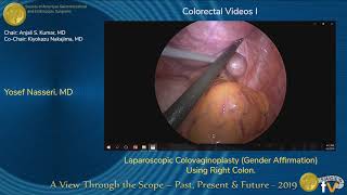 Laparoscopic Colovaginoplasty (Gender Affirmation) Using Right Colon