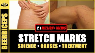 GOODBYE FOREVER - Stretch Marks | Stretch Marks Science, Causes & Treatment | Be