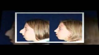 los angeles ca best non surgical nose job rhinoplasty doctor