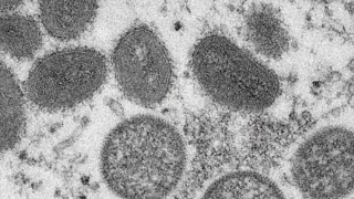 Quest Diagnostics to begin testing for monkeypox