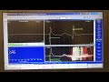 stimulated single fiber electromyography with jitter and blocking