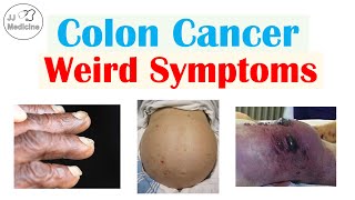 Colon Cancer Weird Symptoms (& Why They Occur)