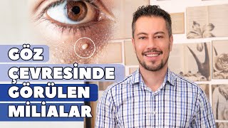 Göz Çevresinde Görülen Milialar