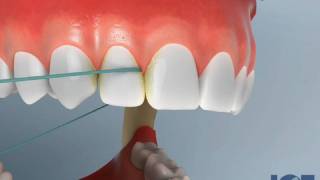 Flossing Upper Teeth
