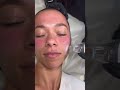 Potenza RF Microneedling at SEV Laser