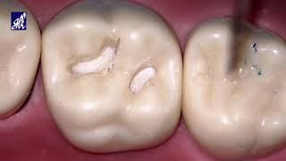 Class I Cavity Preparation Tooth #16