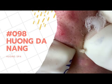 Milk Of Magnesia Acne: Acne Treatment Huong Beauty