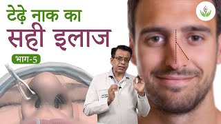 टेढ़ी नाक का सफल इलाज (भाग - 5) । केयर वेल मेडिकल सेंटर