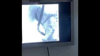 ERCP (Endoscopic Retrograde Cholangiopancreatography) Procedure Video