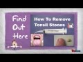 Easiest Way To Get Rid Of Tonsil Stones Naturally At Home Easiest Way To Get Rid Of Tonsil Stones Naturally At Home