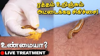 Leech Therapy - அட்டைய கடிக்க விட்டு சிகிச்சையா?😱 | This is how Leech Therapy Done | Live Treatment