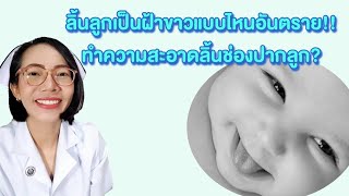 ลิ้นลูกเป็นฝ้าขาวแบบไหนอันตราย ทำความสะอาดลิ้นช่องปากลูก?|แม่โบNurse Kids