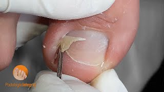 Ingrown toenail \u0026 granuloma [Podología Integral]