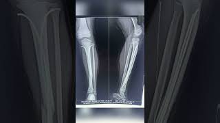 Displaced fracture tibia in kid fixed by TENS system without any cut over fracture site.