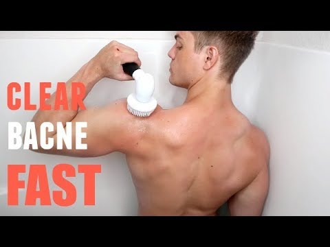 How to Clear Up Back Acne, Dark Spots FAST (Perfect Shower Routine) How to Clear Up Back Acne, Dark Spots FAST (Perfect Shower Routine)
