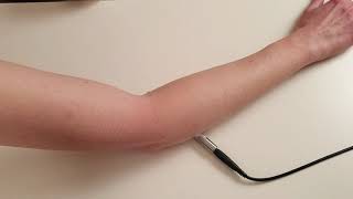 Tecarpuls for tennis elbow - note golfers elbow is the same on the other epicondyle