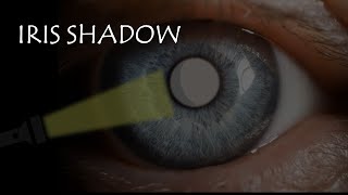 CONCEPT OF IRIS SHADOW | Immature vs Mature cataract