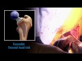 Alteon® Neck Preserving Femoral Stem Animation