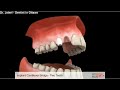 implants implant cantilever bridge two teeth dentist ottawa