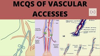 Mcqs of vascular access, Part-2, Fistula cannulation, catherization, rope ladder technique, dialysis