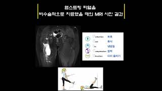 햄스트링 파열을 비수술적으로 치료한 결과 #shorts