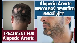 Alopecia Areata | തലയിലുള്ള മുടി വട്ടത്തില്‍ കൊഴിച്ചിൽ | Treatment for Alopecia Areata