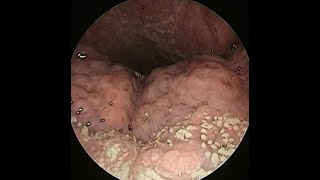 lingual tonsil hypertrophy, lingual tonsil hyperplasia