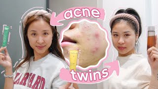 Our HORMONAL ACNE morning routine (+ she steals my skincare)