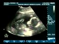 20 Week ultrasound