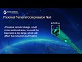 Proximal Femoral Compression Nail