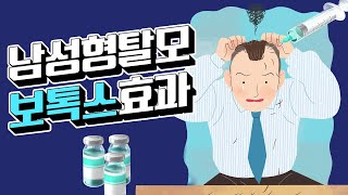 모발이식닥터 Q\u0026A 05. 남성형탈모와 보톡스가 만나면?!