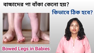 বাচ্চাদের পা বাঁকা কেন হয়? কিভাবে ঠিক হয়? || Bowed legs in babies reason and cure #bowlegs