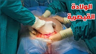 شاهد عملية الولادة القيصرية وقل(سبحان الله الخالق) Cesarean section _ Surgical technique -