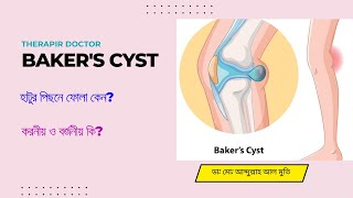 Bekar's Cyst/বেকার সিস্ট/Therapir Doctor