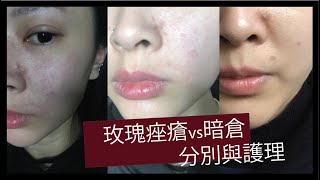 【SKINCARE】玫瑰痤瘡vs暗倉分別與護理  親身慘痛經歷(有圖）