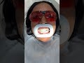 Teeth whitening process