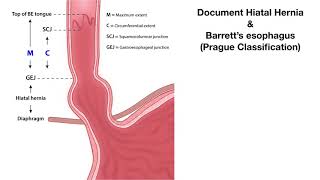 Barrett's esophagus - Prague Classification - Graphic Illustration