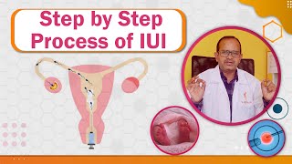 Step by Step Process of IUI | Information about IUI | Success and Failures of IUI