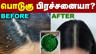 பொடுகு பிரச்சனையில இருந்து தப்பிக்க இது தான் வழி! | dandruff treatment at home | Men \u0026 Women