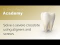 Planification for severe Crossbite   using aligners