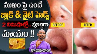 ముక్కు ఇంకా ముఖం పై ఉండే బ్లాక్ \u0026 వైట్ హెడ్స్ పూర్తిగా మాయం | Dr. Madhu Babu | Health Trends |